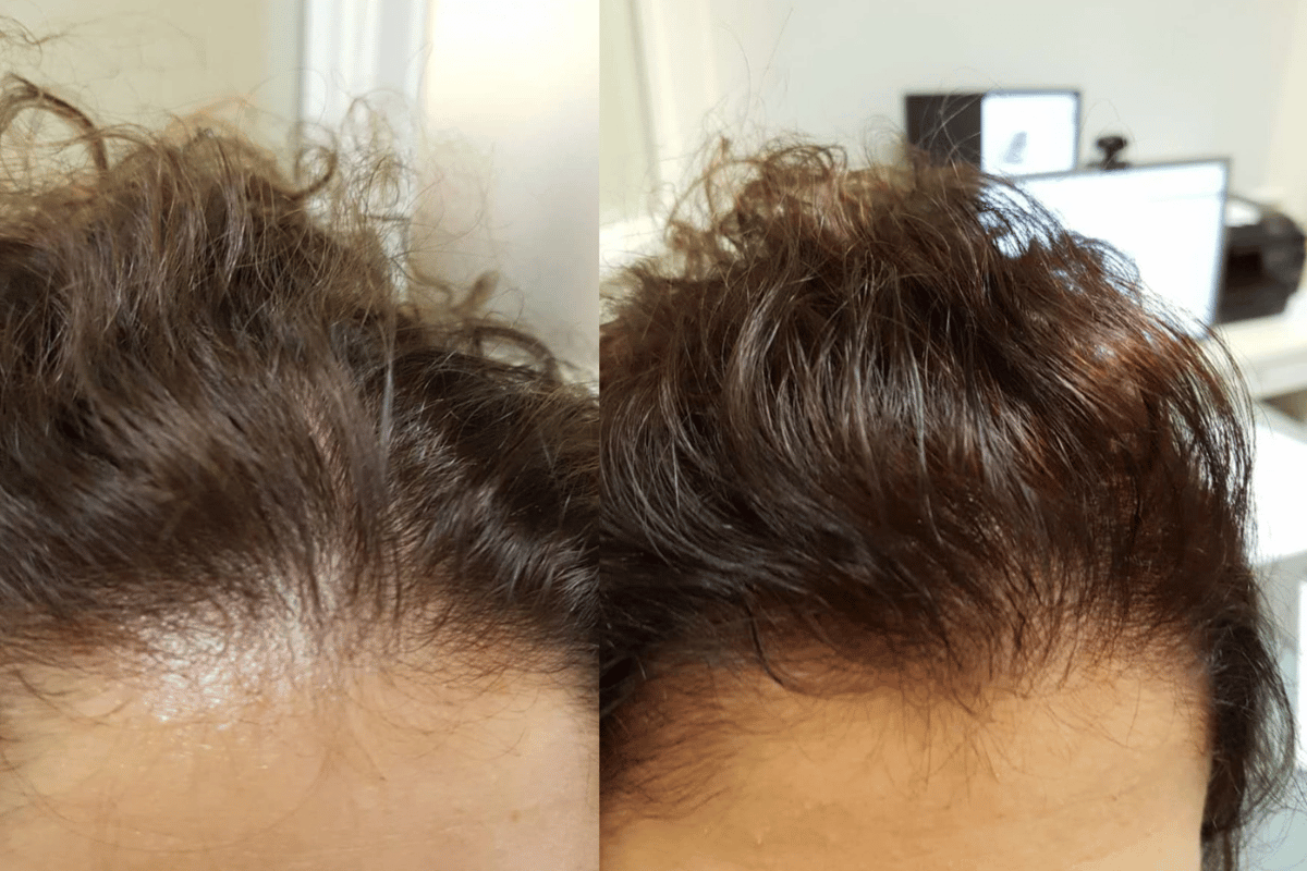 Frontale fiobroserende alopecia